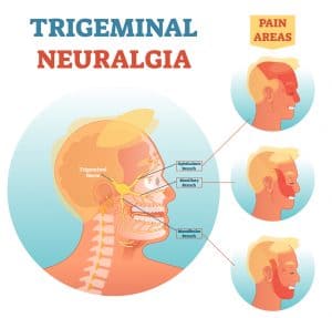 Trigeminal neuralgia pain areas
