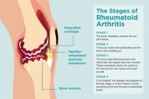 stages of Rheumatoid Arthritis 